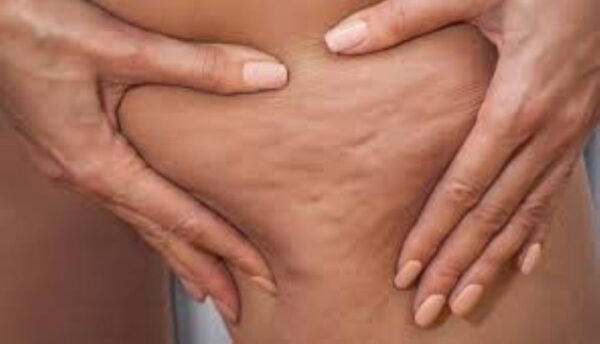 how to get rid of cellulite