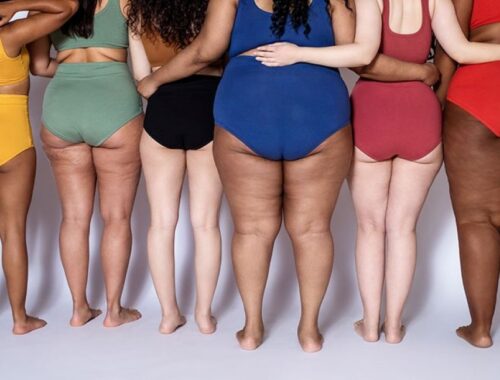 Cellulite is a very common, harmless skin condition that causes lumpy, dimpled flesh on the thighs, hips, buttocks and abdomen.